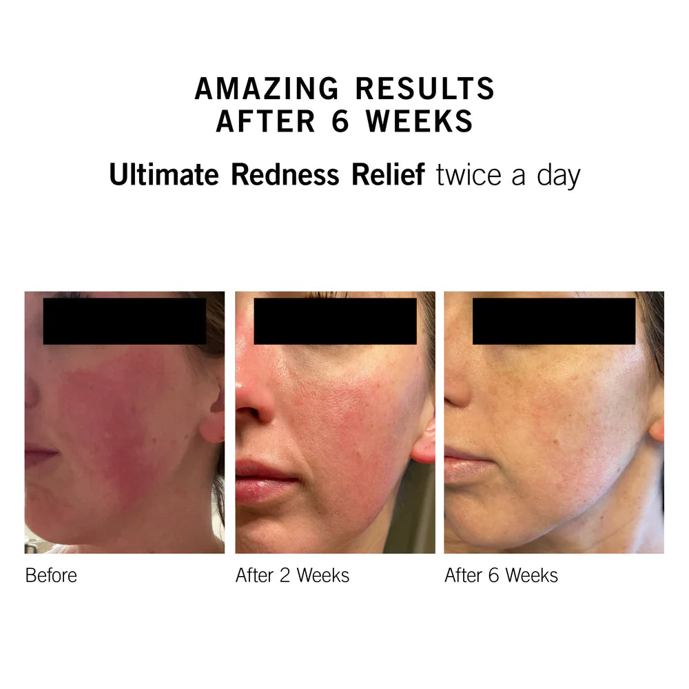 Ultimate Redness Relief
