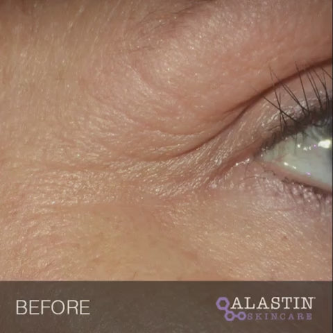 Alastin Restorative Eye Treatment