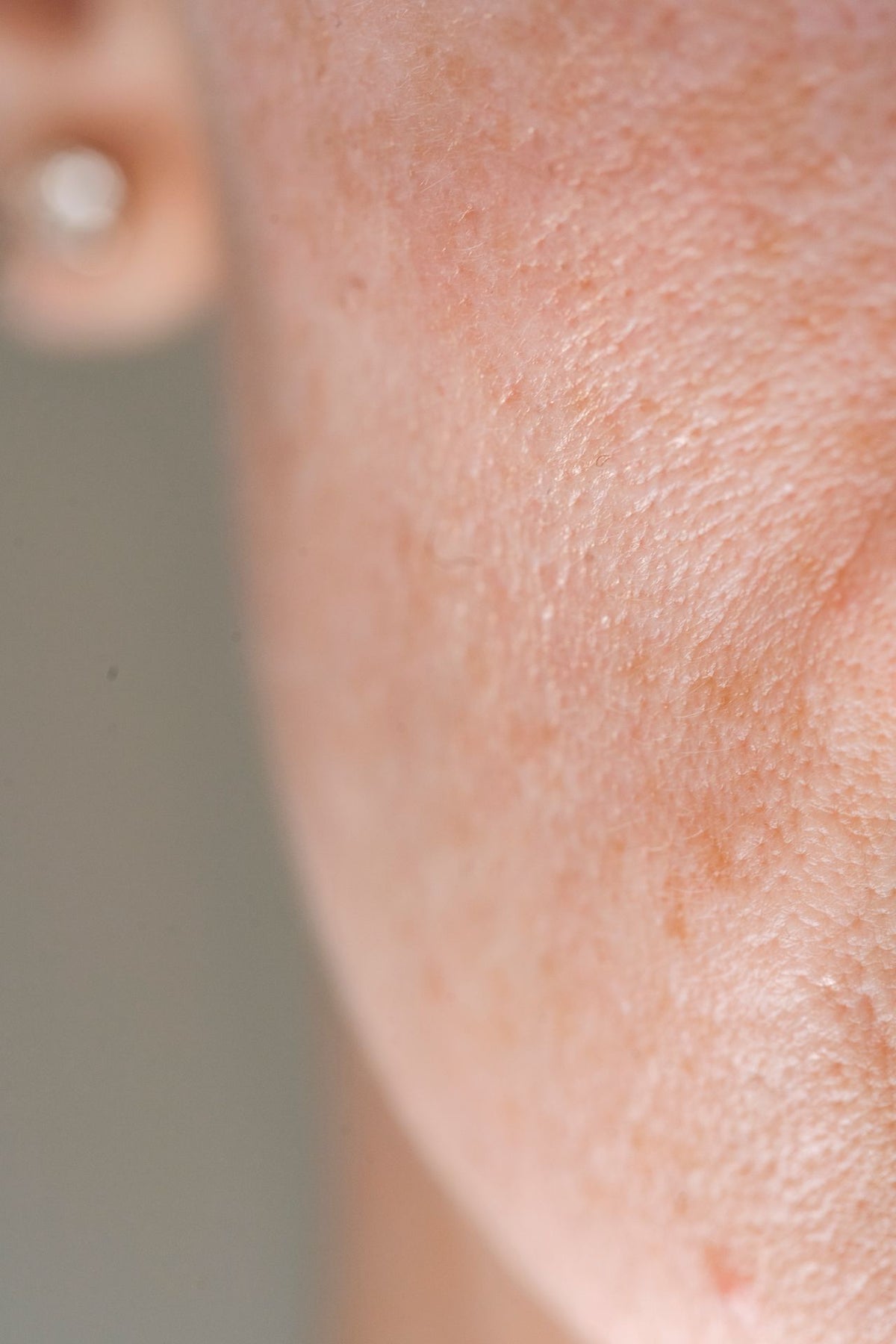 Dry Skin