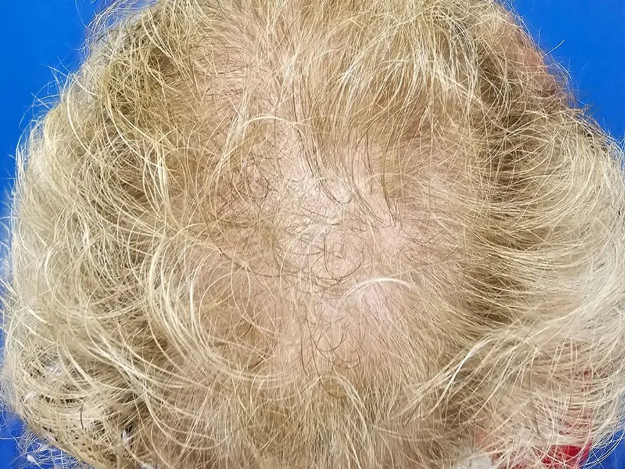 Xtresse Hair Growth Gummies